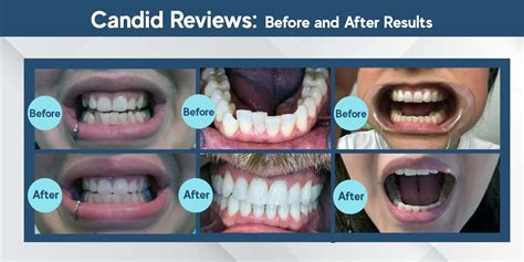 candidbestpremium.com|candid clear aligners reviews.